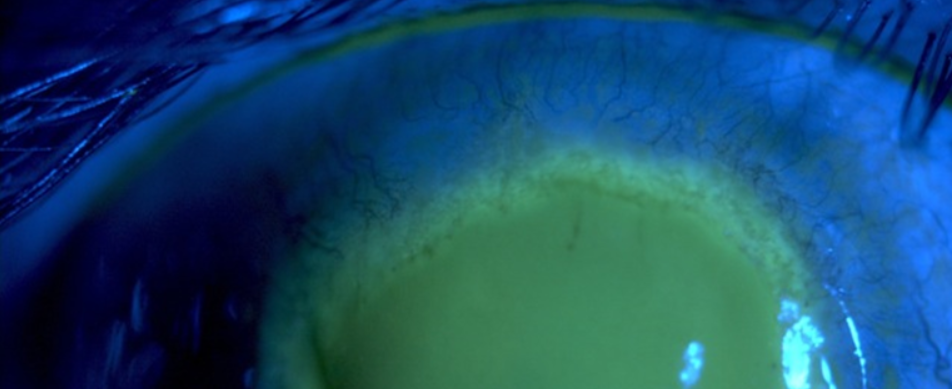 Information-acanthamoeba-keratitis